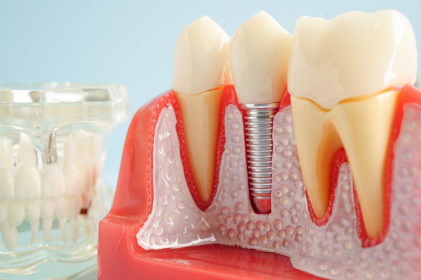 Smile Again With Dental Implants