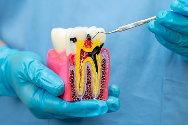 Three Signs You May Need A Root Canal